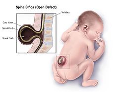 Spina-bifida